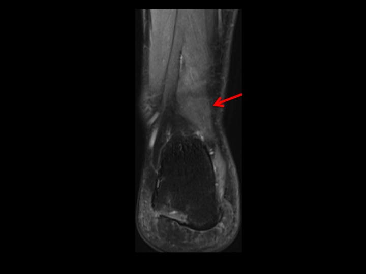 Figure 4 for case accessory flexor muscle